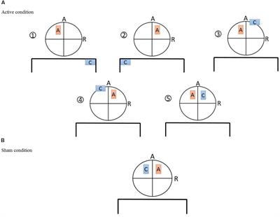 Optimizing Electrode Montages of Transcranial Direct Current Stimulation for Attentional Bias Modification in Early Abstinent Methamphetamine Users